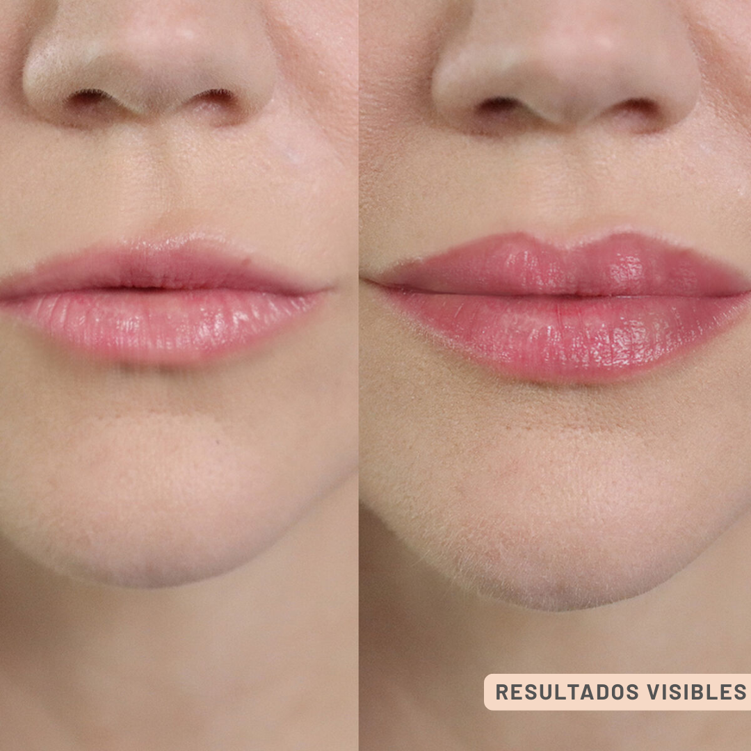 Rodillo Voluminizador de Labios  + ácido hialurónico