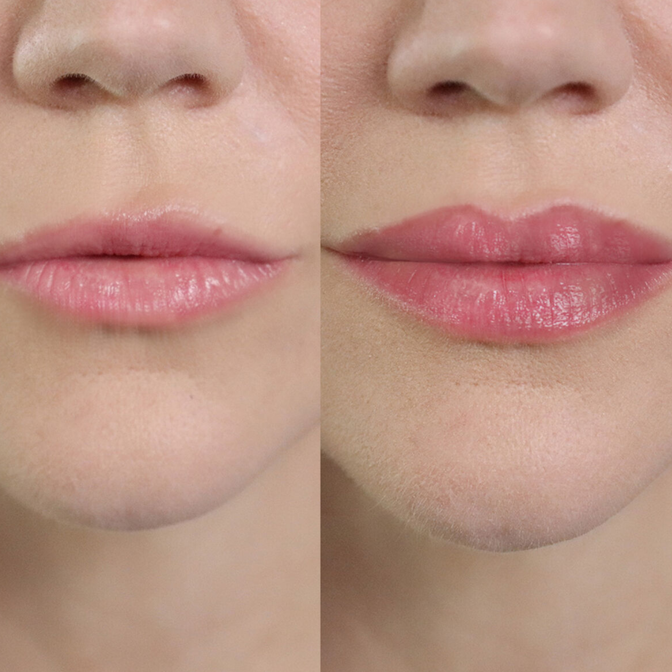 Rodillo Voluminizador de Labios + ácido hialurónico